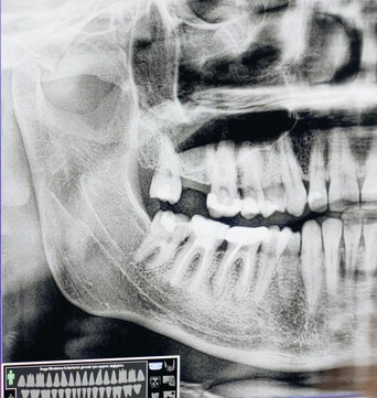 jaw bone x-ray x-ray of a jaw bone
