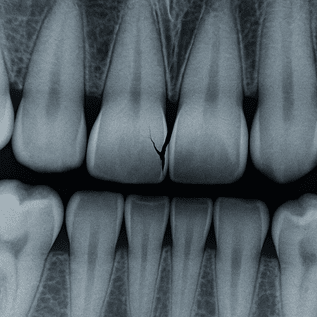illustration of an x-ray of a cracked tooth